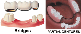 DENTURES-AND-BRIDGES.gif
