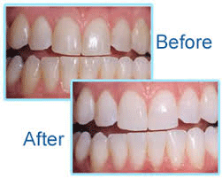 WHITENING.gif