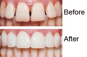 VENEERS.gif