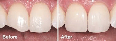TOOTH-BONDING.gif