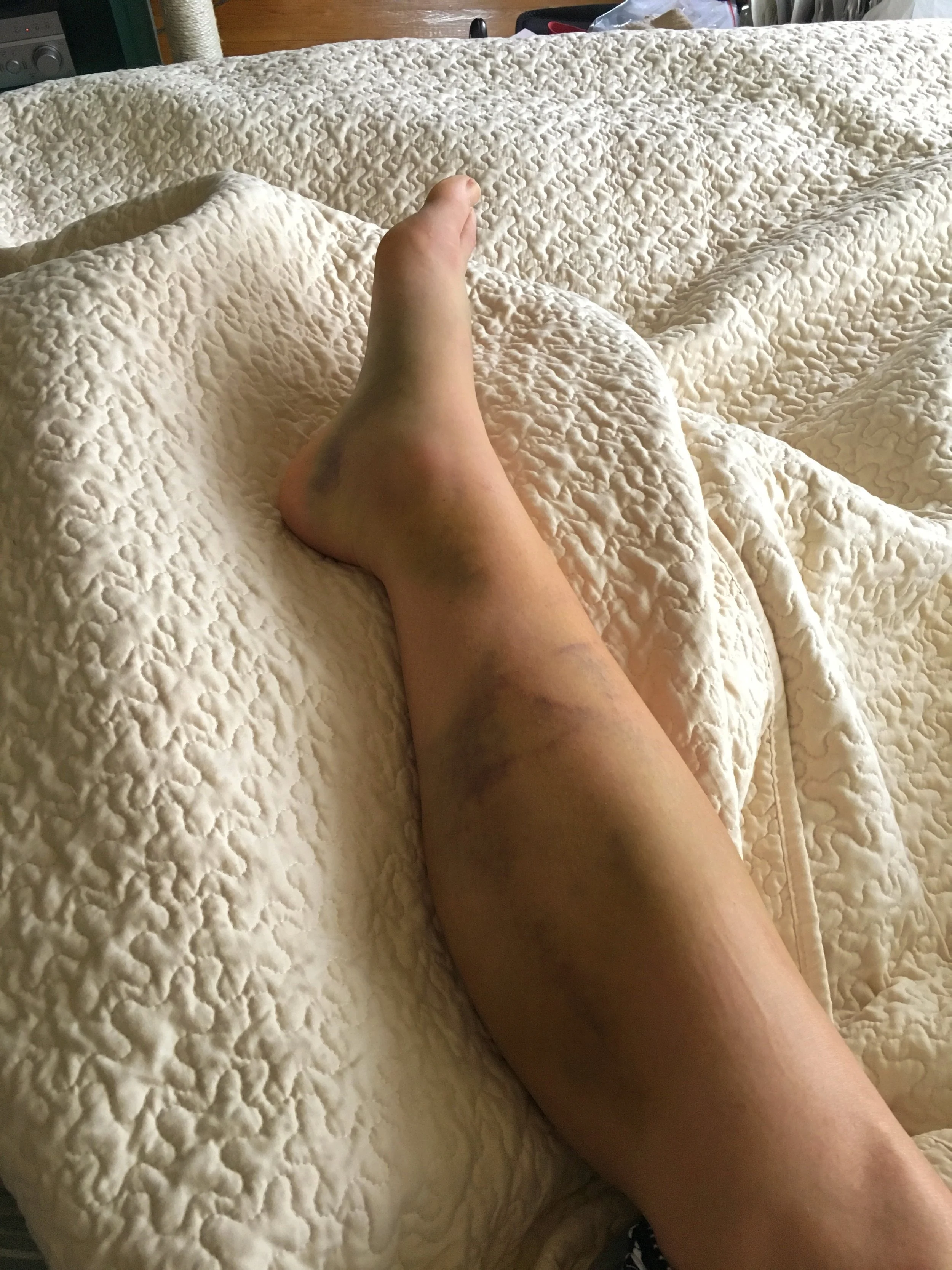 The bruising covered my entire calf and the bottom of my foot.