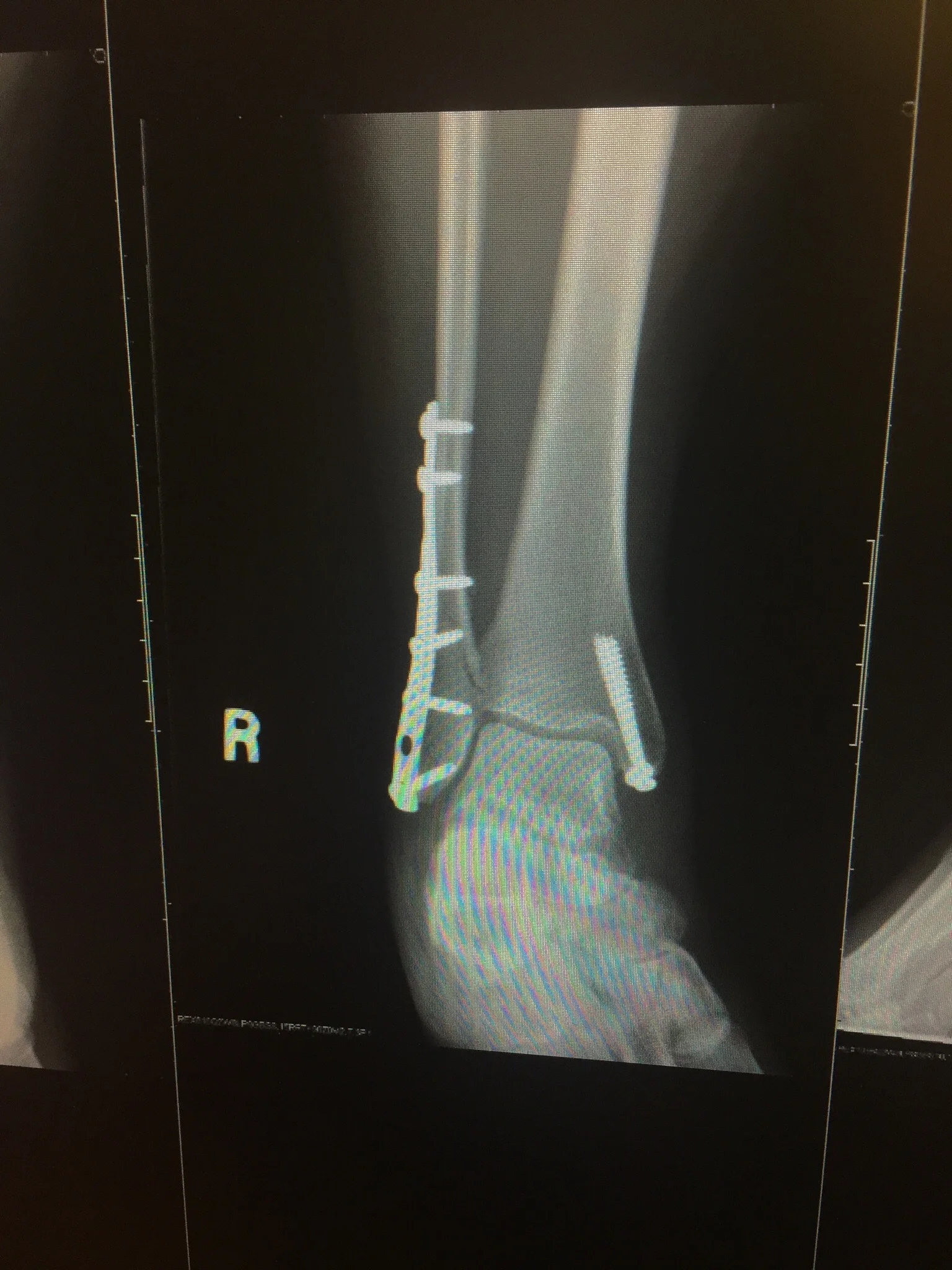One 5" metal plate and eight screws.