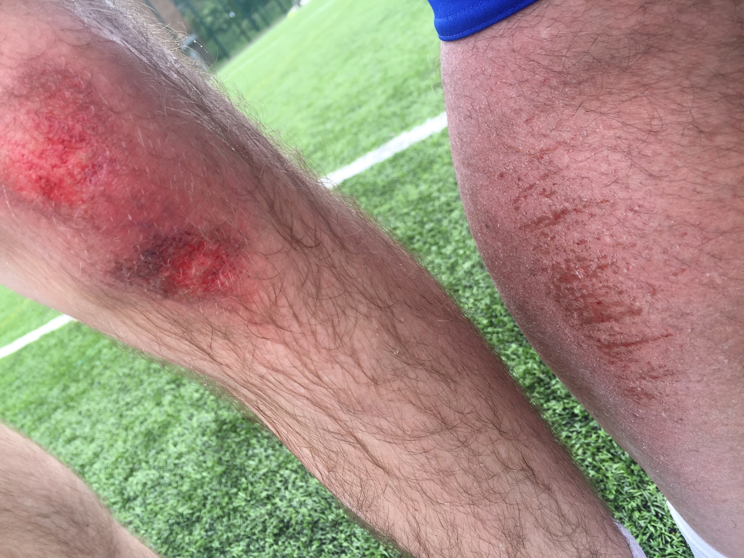 Sure Callum's leg 'looks' worse than mine!