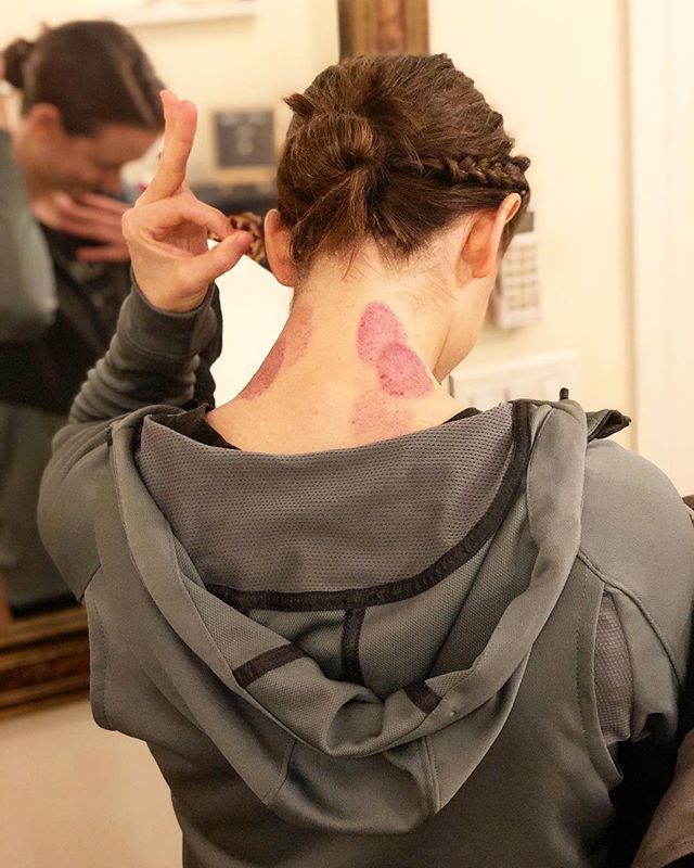 C O N T E S T!
~~~~~~~~~~~~
Attention anatomy nerds 🤓 Name at least *2 muscles* where this patient holds her tension (i.e. where her cupping marks are), and we&rsquo;ll give you 50% off one treatment! .
We thought we&rsquo;d do this to try to spruce