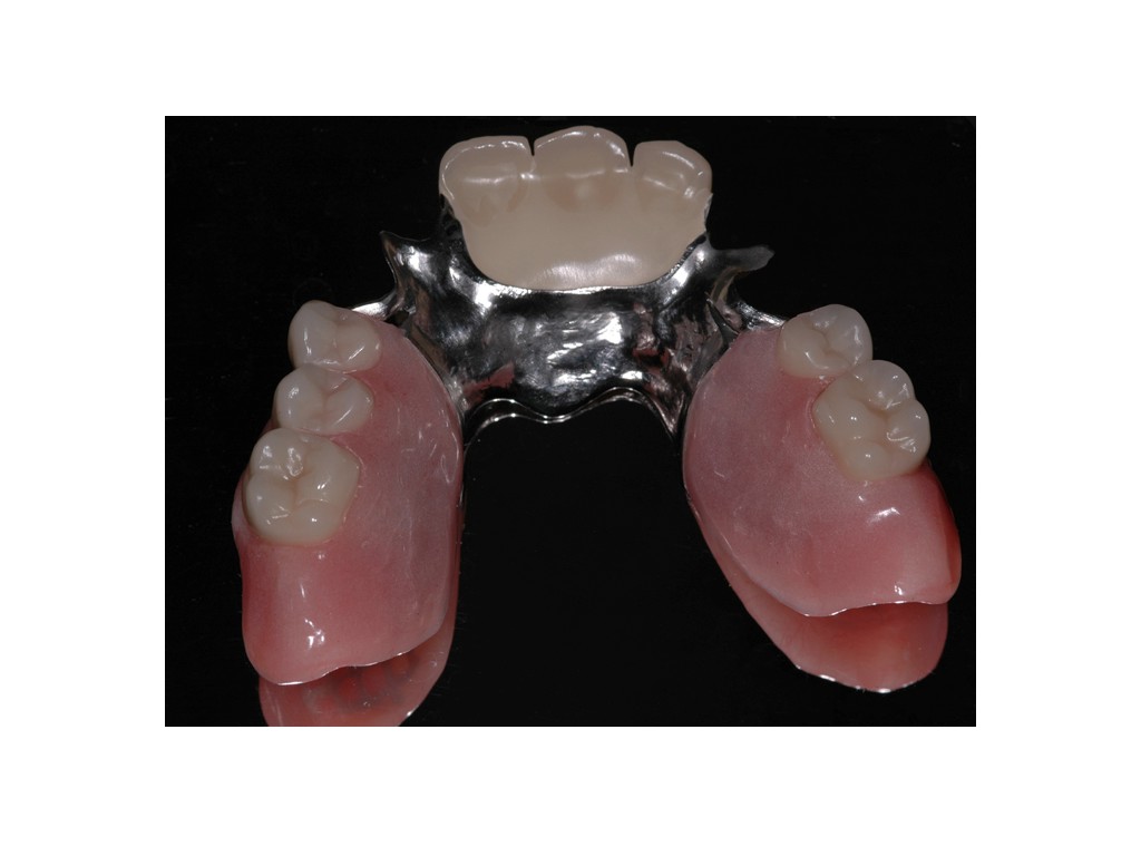 Partial denture4.jpg