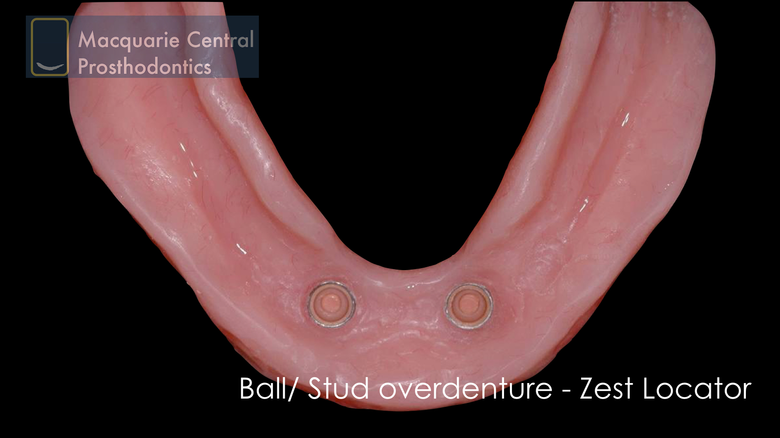 ball overdenture straumann locator zest lower denture.jpeg