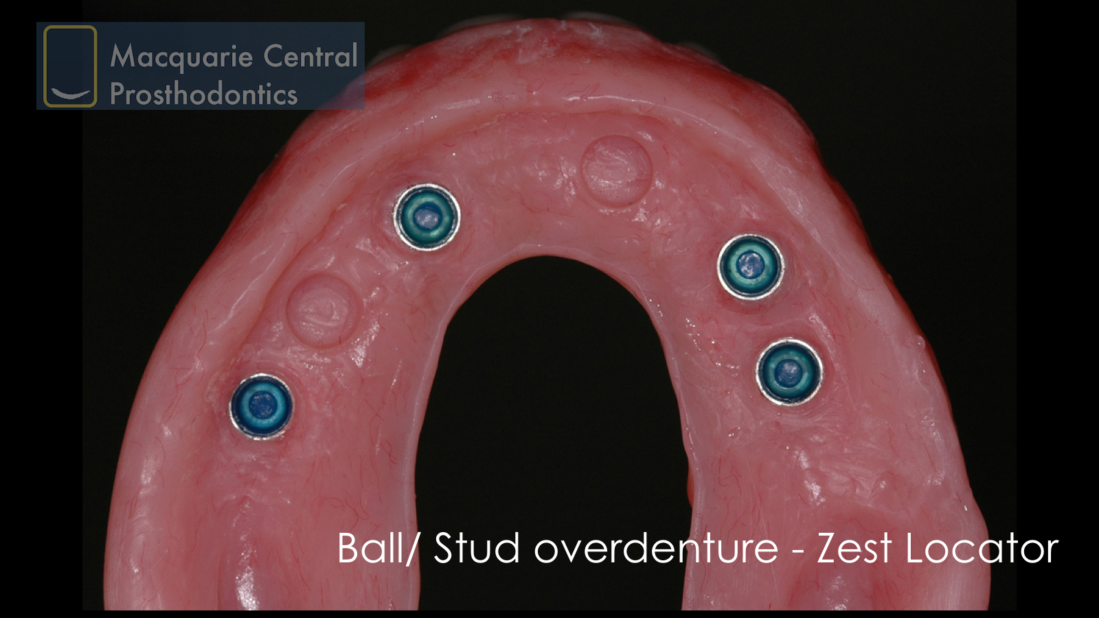 ball overdenture straumann locator zest upper denture.jpeg