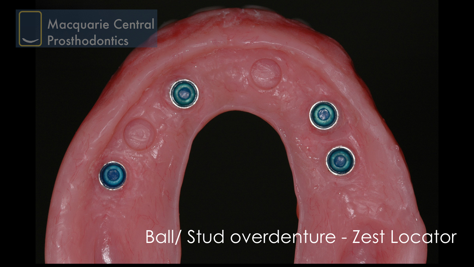 Removable implant overdenture — Macquarie Central Prosthodontics