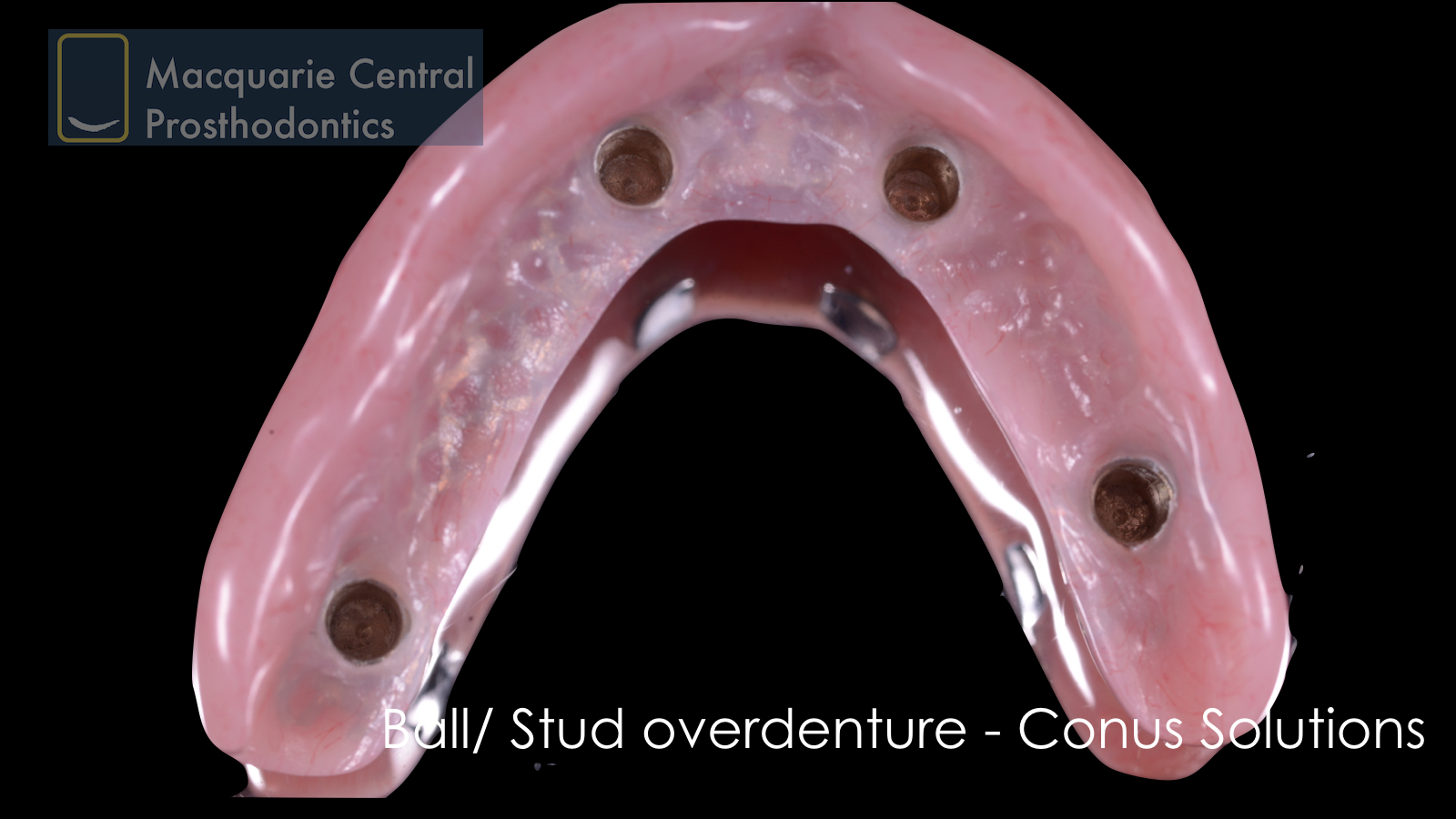 ball overdenture Dentsply conus solution upper denture.jpeg