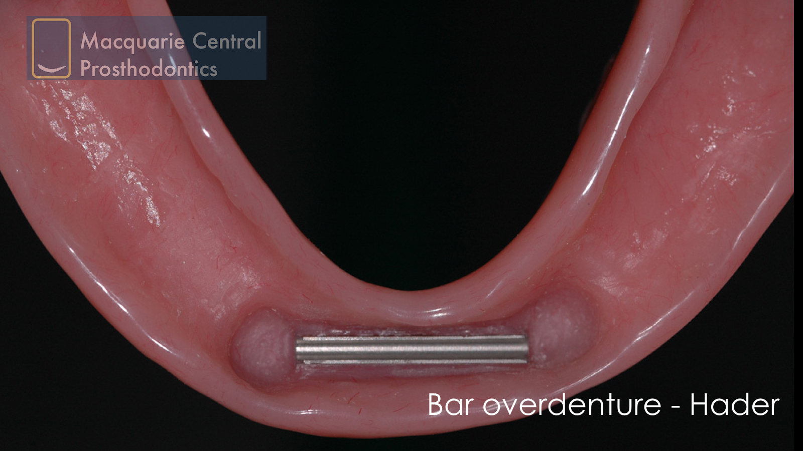 bar overdenture hader lower straumann denture.jpeg