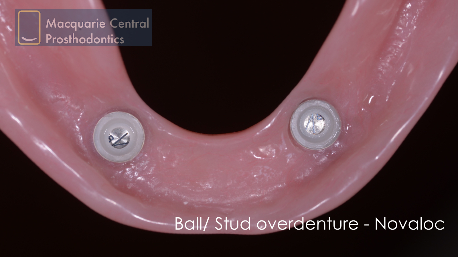 ball overdenture straumann novaloc lower denture.jpeg