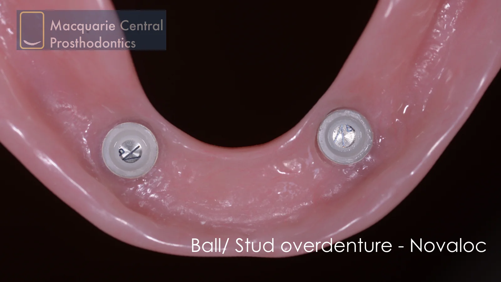 Removable implant overdenture — Macquarie Central Prosthodontics