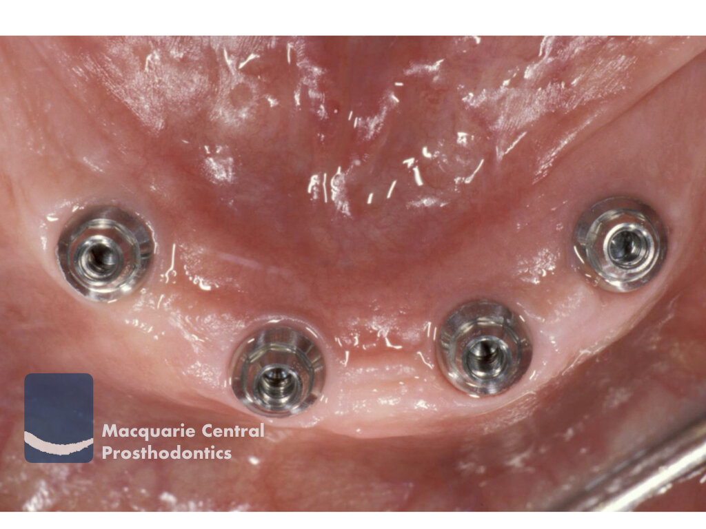 Fixed implant overdenture bridge2.jpeg