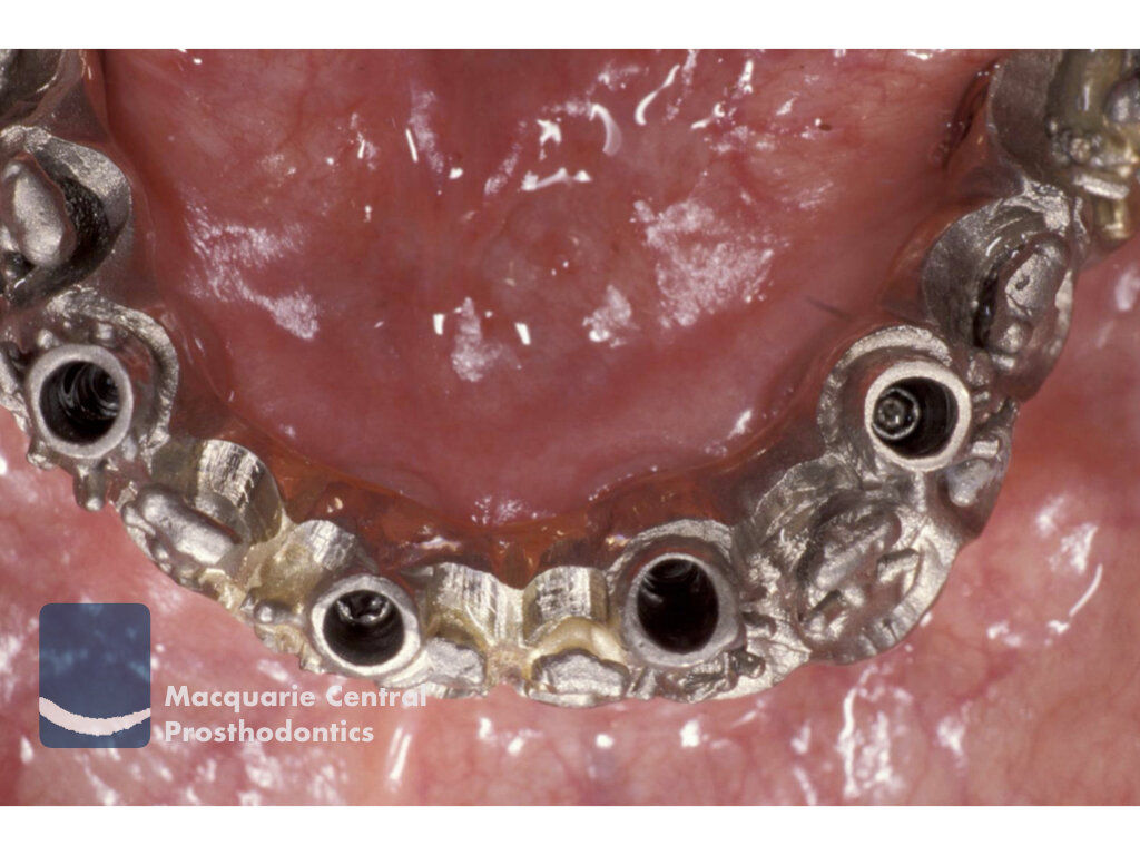 Fixed implant overdenture bridge3.jpeg