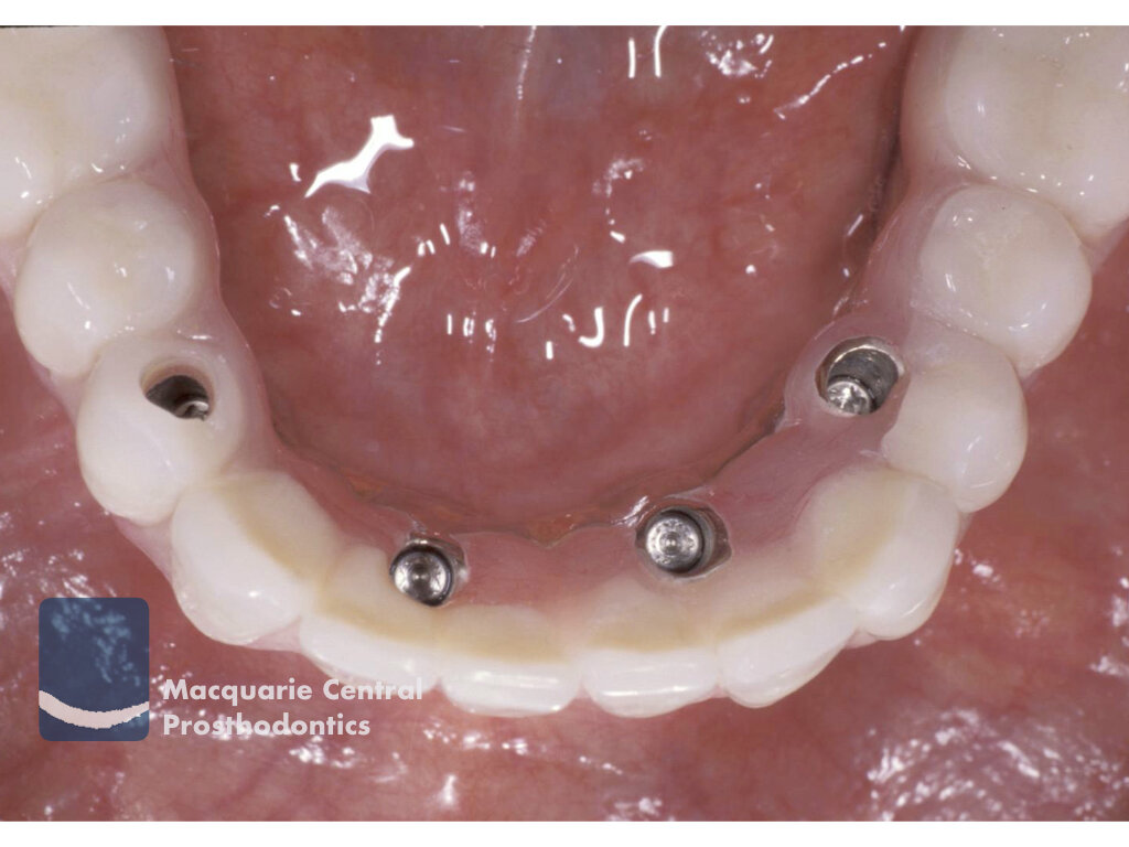 Fixed implant overdenture bridge4.jpeg