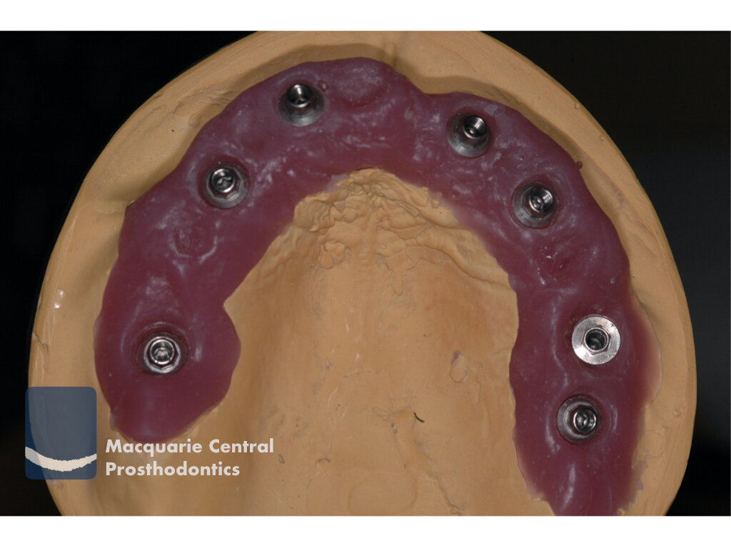 Fixed implant bridge.jpeg