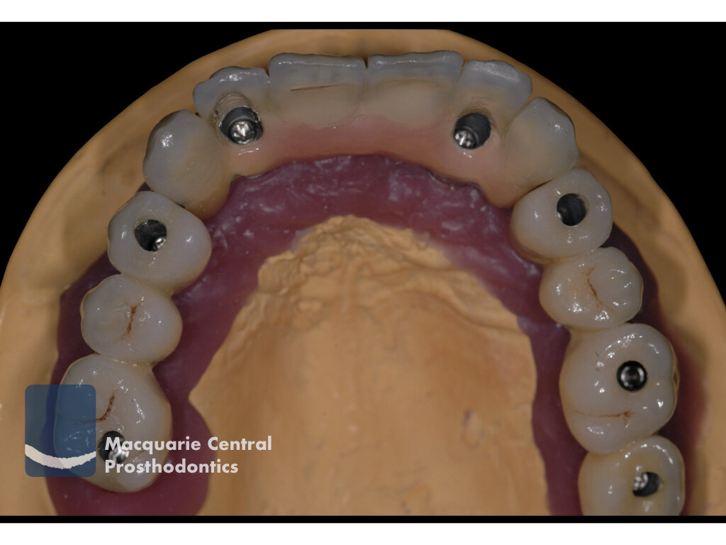 fixed implant bridge Sydney Santosa.jpeg