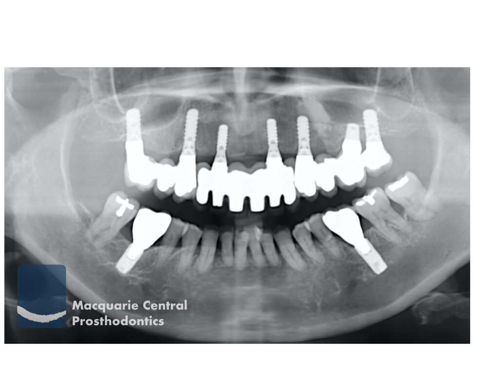 fixed implant bridge Sydney xrays.jpeg