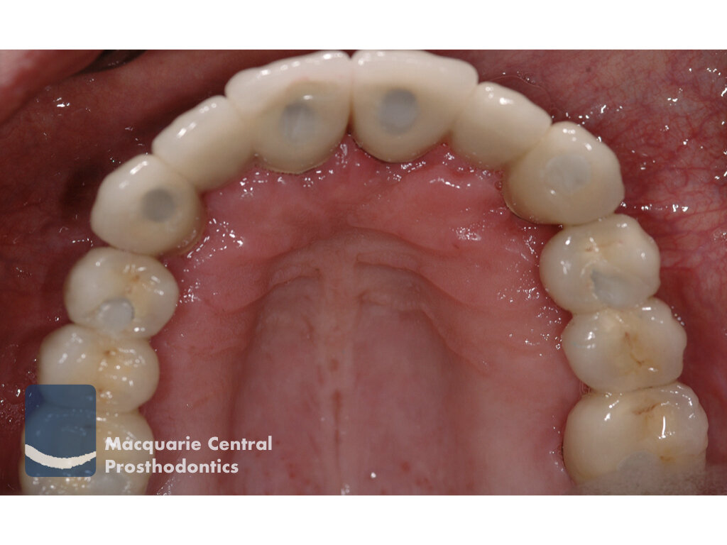 Fixed implant overdenture bridge.jpeg