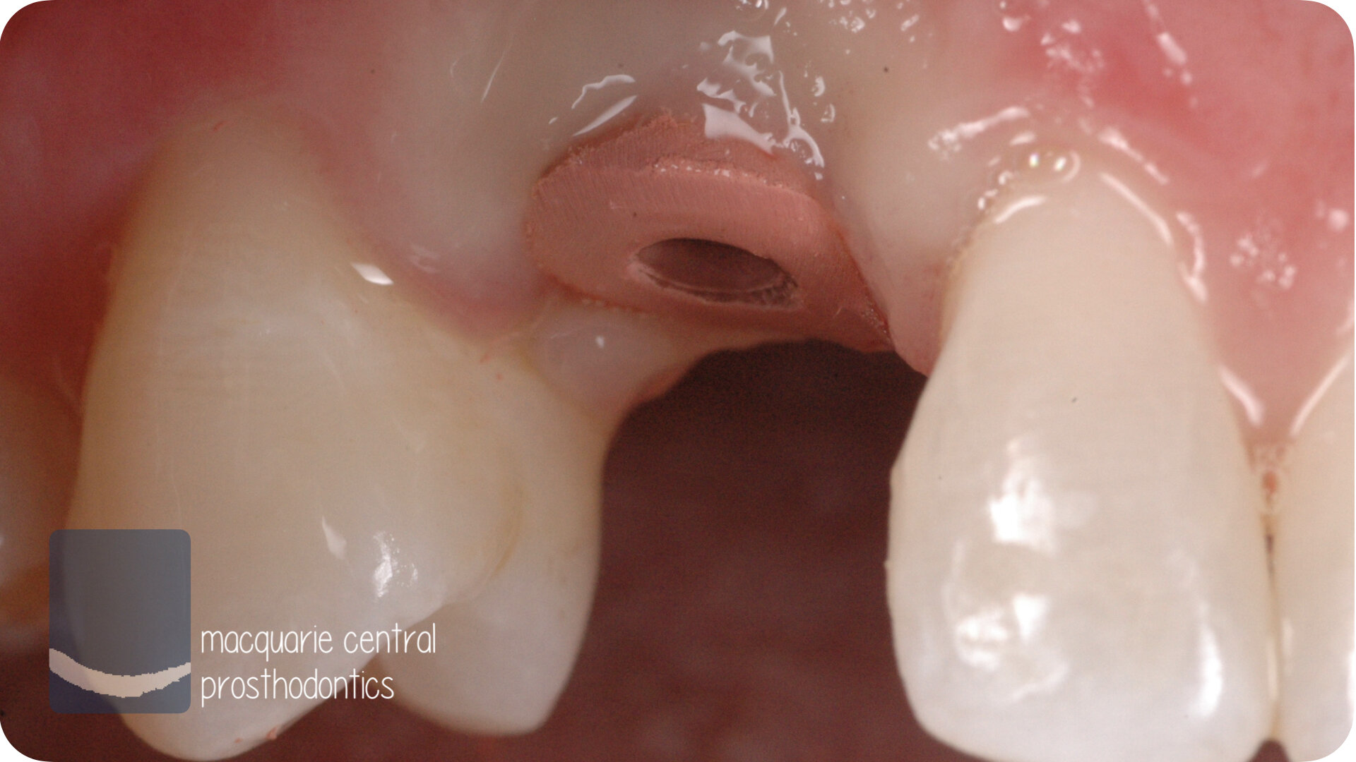 implant sydney dentist 2.jpeg