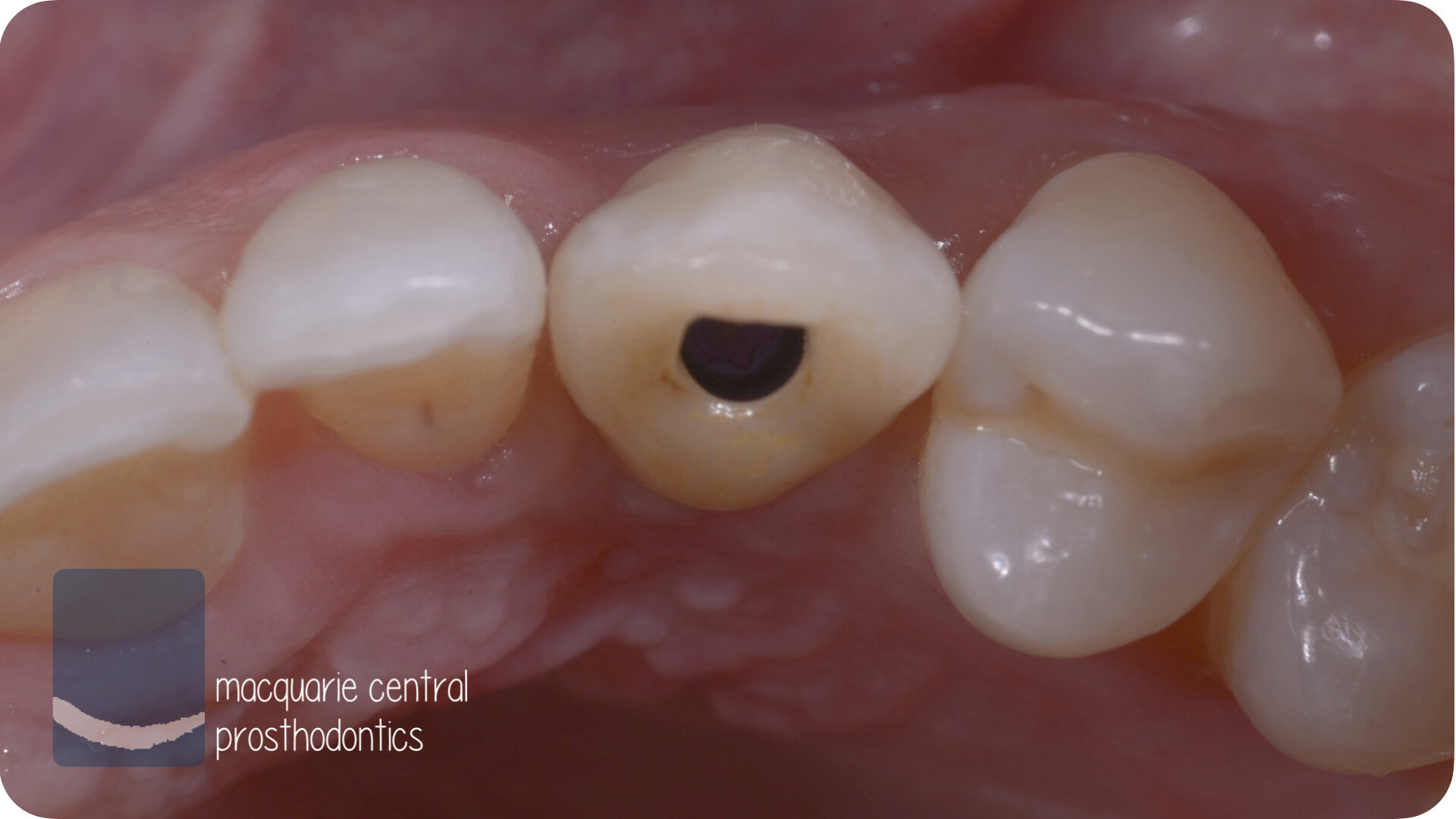implant sydney dentist 5.jpeg