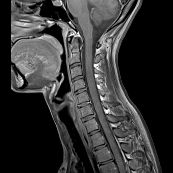 MRI Disc Herniation from Car Crash.jpeg