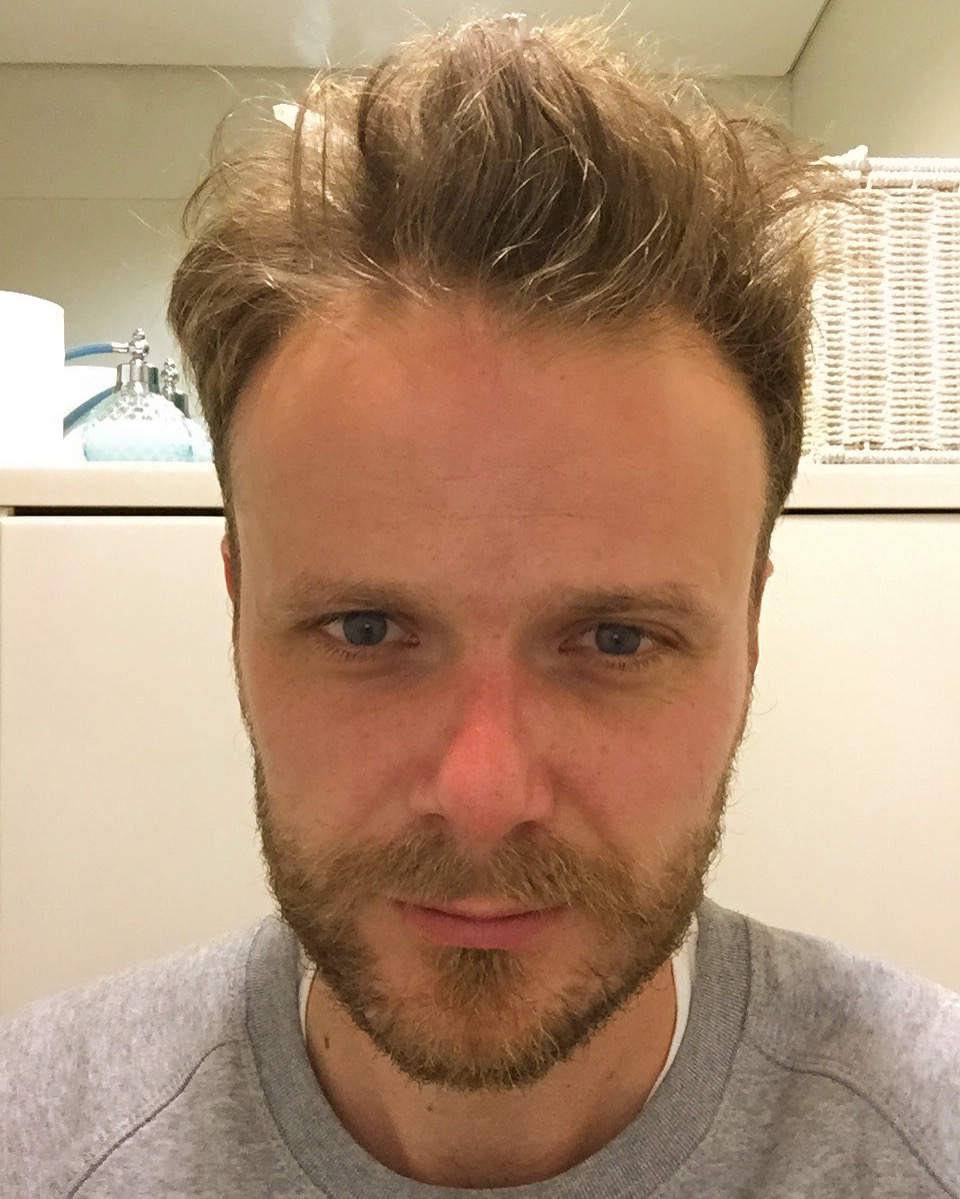 FRESH AS A DAISY (A DAISY WITH BAD HAIR)... OBLIGATORY SELFIE IN THE LOO TO HIGHLIGHT MY POST-TREATMENT FACE.