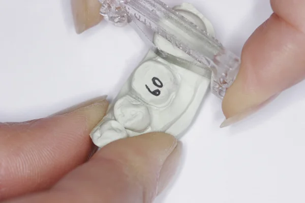 Fig. 1 - The mesial proximal surface of adjacent tooth #20 is scraped by a Lab Stone Strip 4 times.