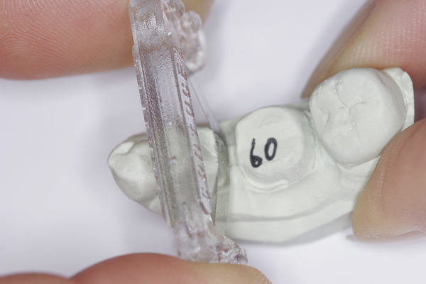 Fig. 2 - The distal proximal surface of adjacent tooth #20 is scraped by a Lab Stone Strip 4 times.