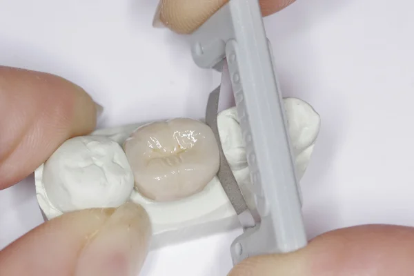 Fig. 5 - After glazing, the crown is adjusted on its mesial proximal contact by a Lab Glaze Strip.