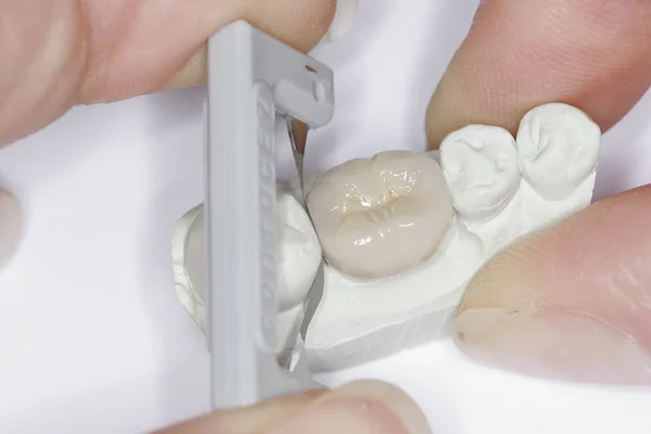 Fig. 6 - The distal proximal contact is adjusted and the crown fabrication is complete. No buffing or polishing is necessary.