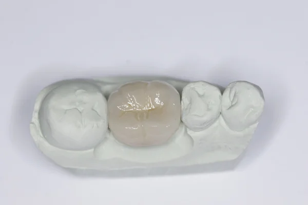 Fig. 7 - The completed crown on the solid stone model.