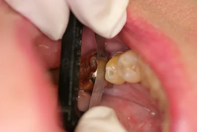 Fig. 1 - The proximal surface of the neighboring gold crown is cleaned and contoured by removing sharp corners with the Black Diamond Strip.