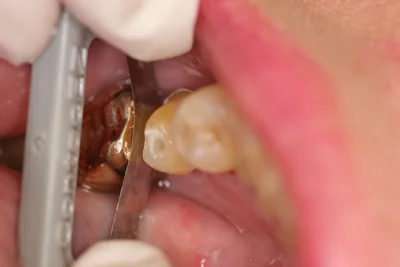 Fig. 2 - The proximal surface of the neighboring crown is polished. Now it is significantly easier to obtain an accurate, detailed impression for the new crown.