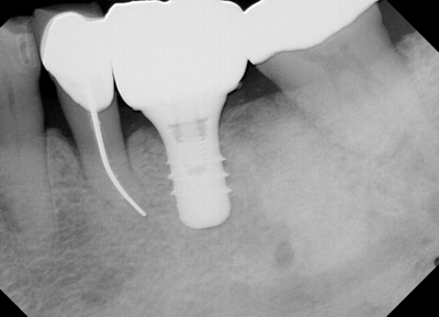 Fig. 1 - Using the ContacEZ Restorative Strip System, an implant crown is adjusted and achieves complete marginal seating to restore Interproximal Relief.