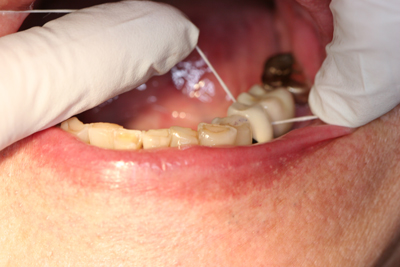 Fig. 2 - The proximal contact adjustment is done superbly, as not only does floss snap in and out of the contact effectively, but the patient feels comfortable as if the crown is his own, natural tooth.