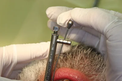 Fig. 1 - Begin proximal contact adjustment with the torque wrench at 5 lbs. of force. At this point, the crown will still be somewhat loose on the implant, so the Black Diamond Strip will readily gain interproximal access. Gradually tighten up to 35 lbs, stopping every 5 lbs. to continue contact adjustment.
