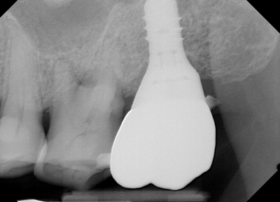 Fig. 2 - After cement is removed, another x-ray reveals that cement is trapped in the sub-gingival area. The excess cement can then be removed and the interproximal surface can be polished with the ContacEZ Sub-Gingival Strips.