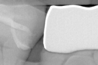 Fig. 1 - Improperly seated crowns, as shown in the above x-ray, tend to be uncomfortable in patients’ mouths and often cause a number of iatrogenic side-effects. These can include food impaction from improper deflection, over-sensitivity, and the development of carious legions under the crown.