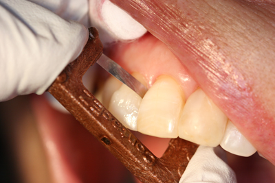 Fig. 1 - Designed with a narrow, thin blade and an extra-fine diamond grit, the Copper Narrow Strip effortlessly accesses sub-gingival spaces. Use it to ensure a complete and thorough clean prior to placing the composite.