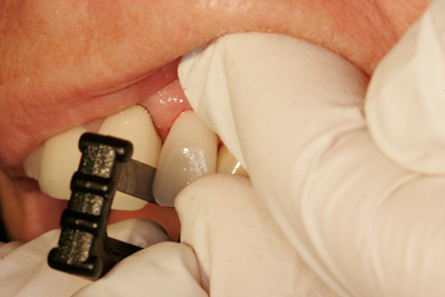 Fig. 2 - The Black Diamond Strip refines the proximal surface, clearing away the plaque that the resin will not properly bond with and priming the surface. The increase in bond strength will help guarantee long-lasting fillings for you and your patients.
