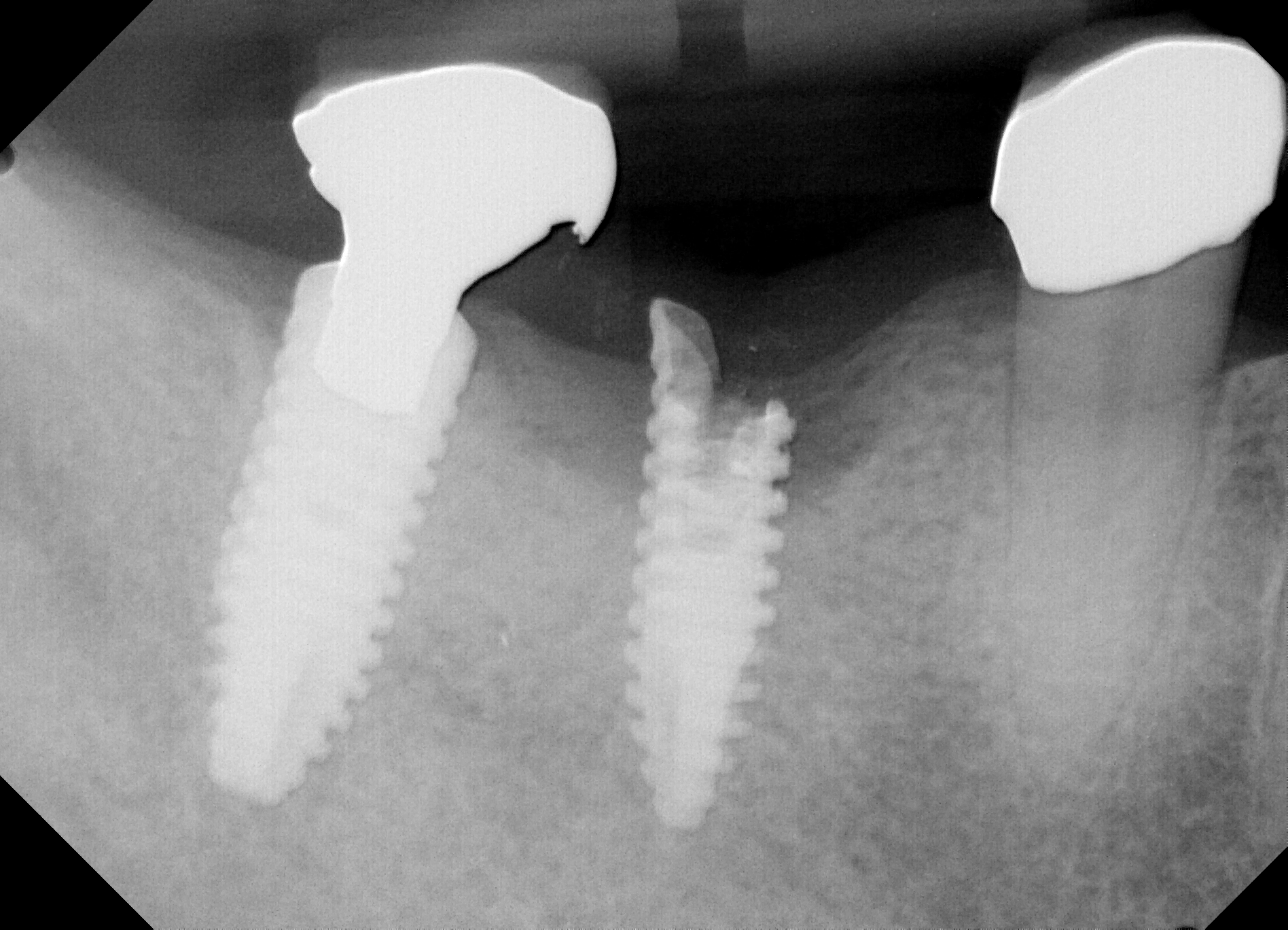 Fig 1. The broken endosteal implant remaining in the mandible needs to be removed for a new restoration.