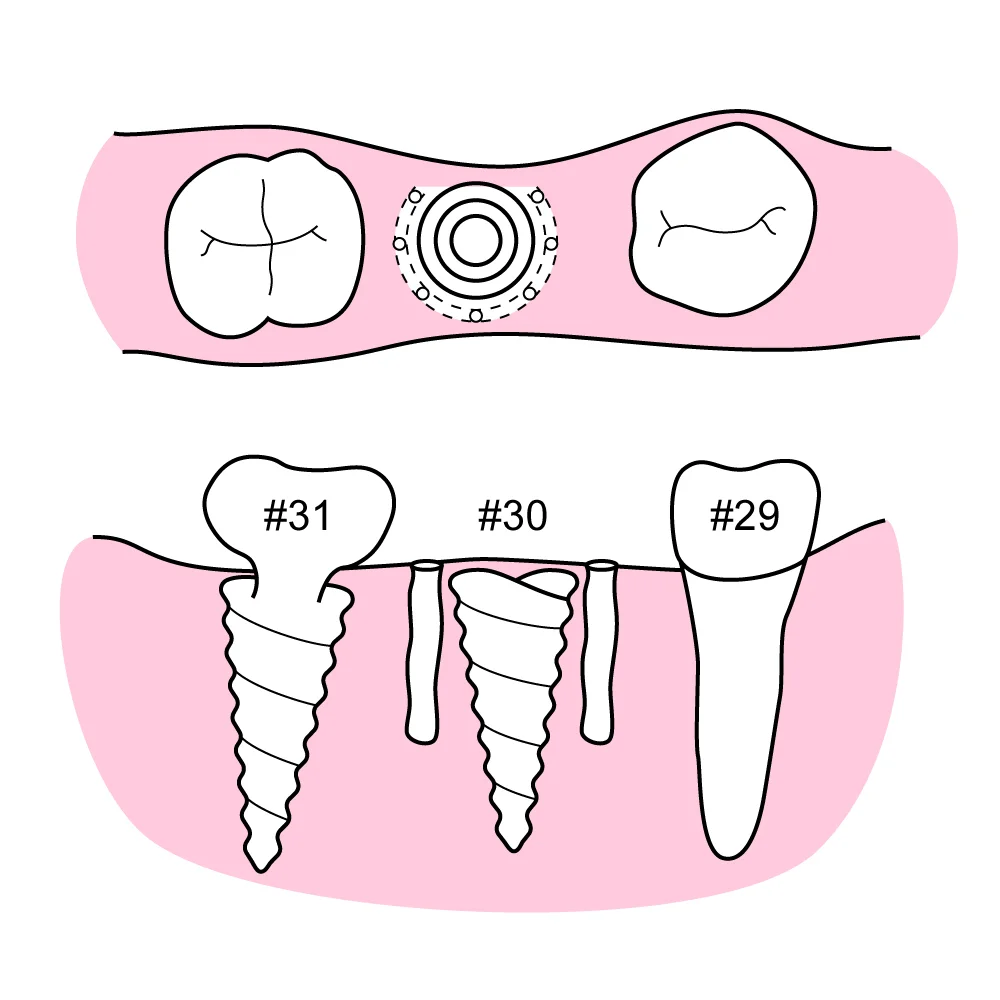Fig 2. After incision along the gingival crest, a carbide bur #330 was used to drill holes around the broken implant body, except on the lingual plate side. Using the same carbide bur #330, the holes were connected to make a trench around the broken implant body, except on the lingual plate side. Using a small elevator #301, the implant body was pushed, and bingo, the implant body tipped over without damaging the lingual plate and was removed with a cotton plier.