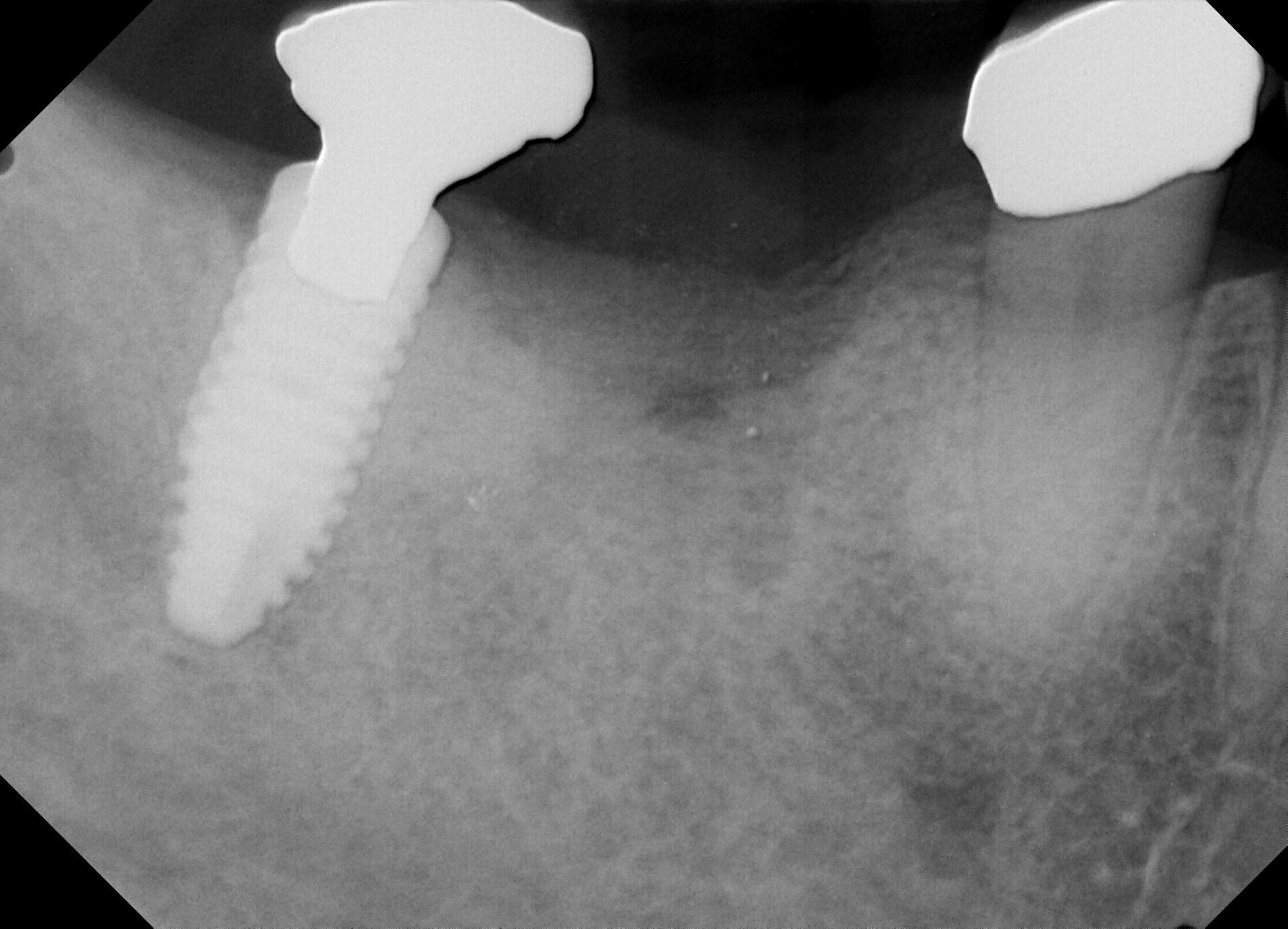 Fig 3. Immediately the site was bone grafted and primary sutured.