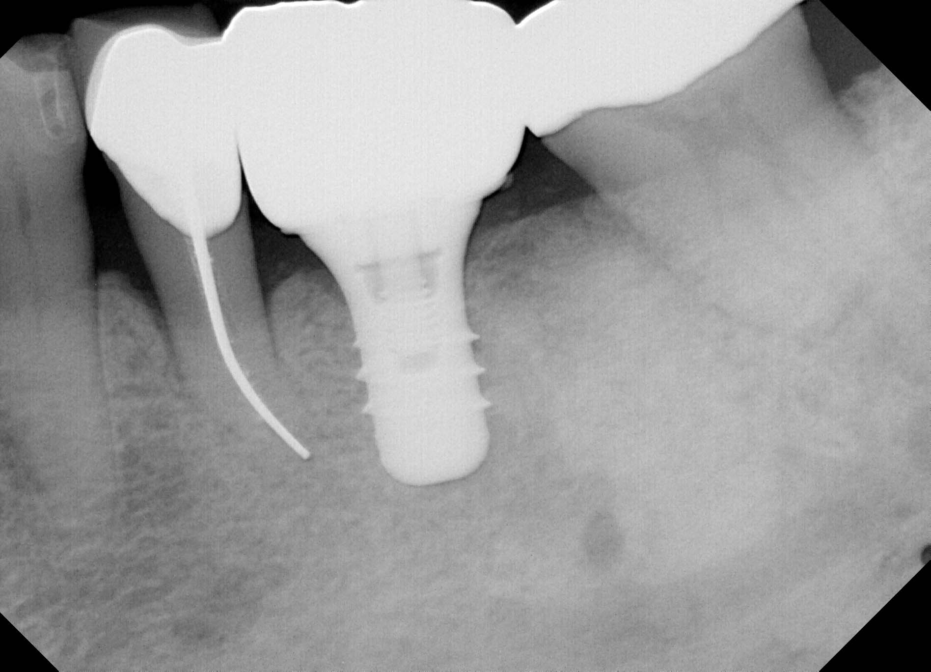 Fig 1. The ideal proximal contact of an implant-supported crown #19 is adjusted using the ContacEZ Black Diamond Strip prior to cementation, and complete marginal seating is achieved.