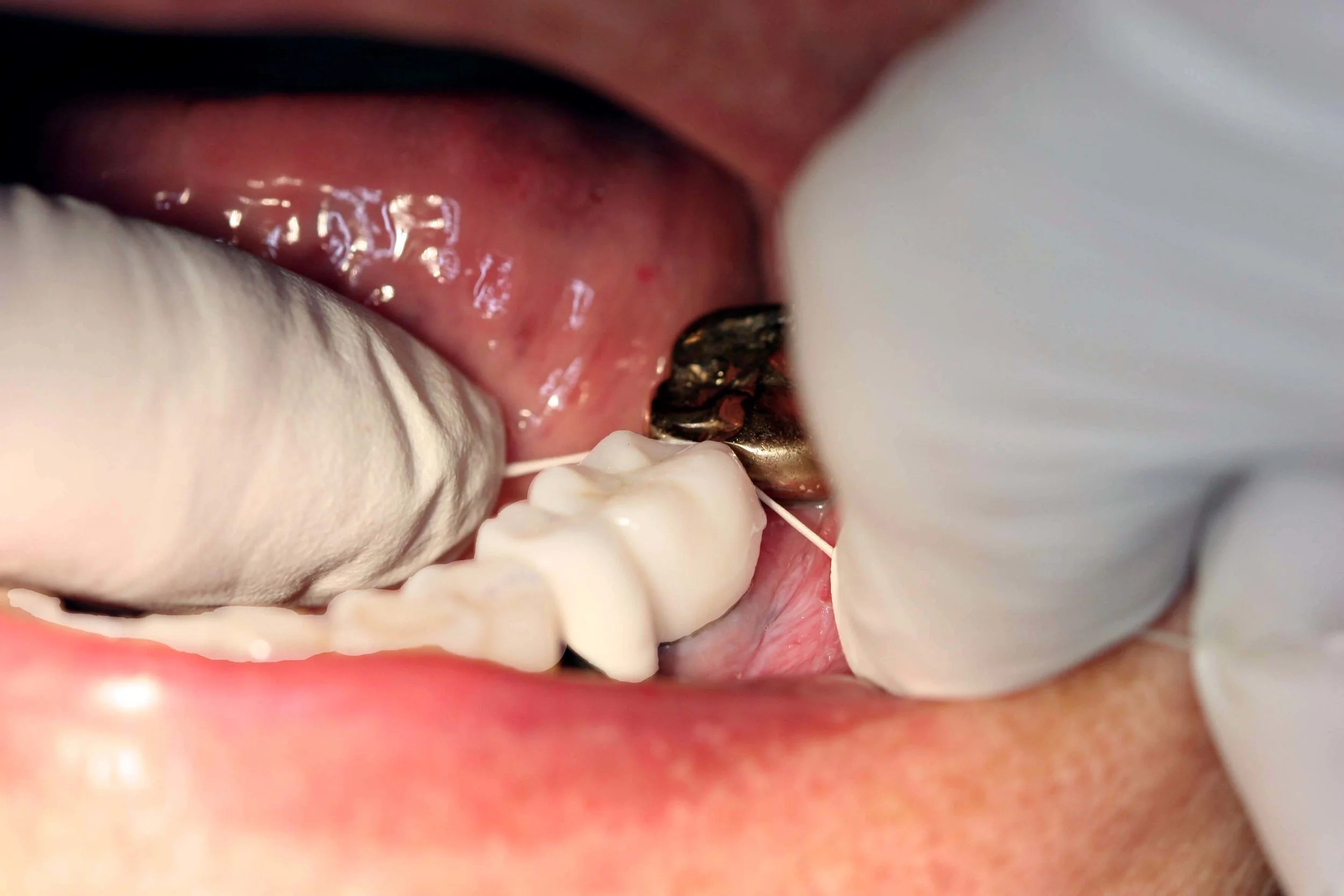 Fig 3. Floss firmly snaps (pops) in and out, but it is not sufficient enough alone to check proximal contact adjustment of a new crown, due to its inconsistency of thickness.