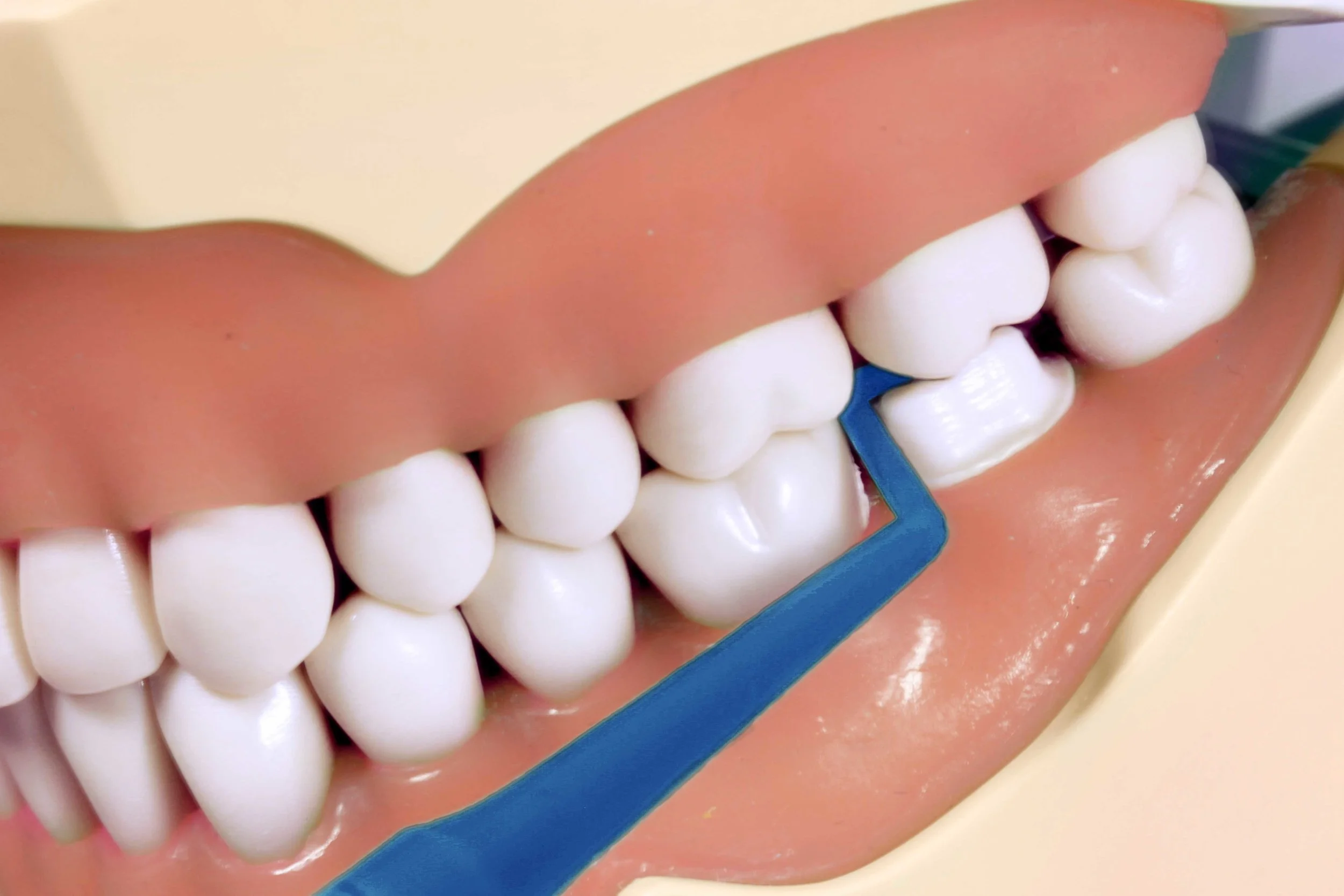 M Tip confirms mesial-half clearance