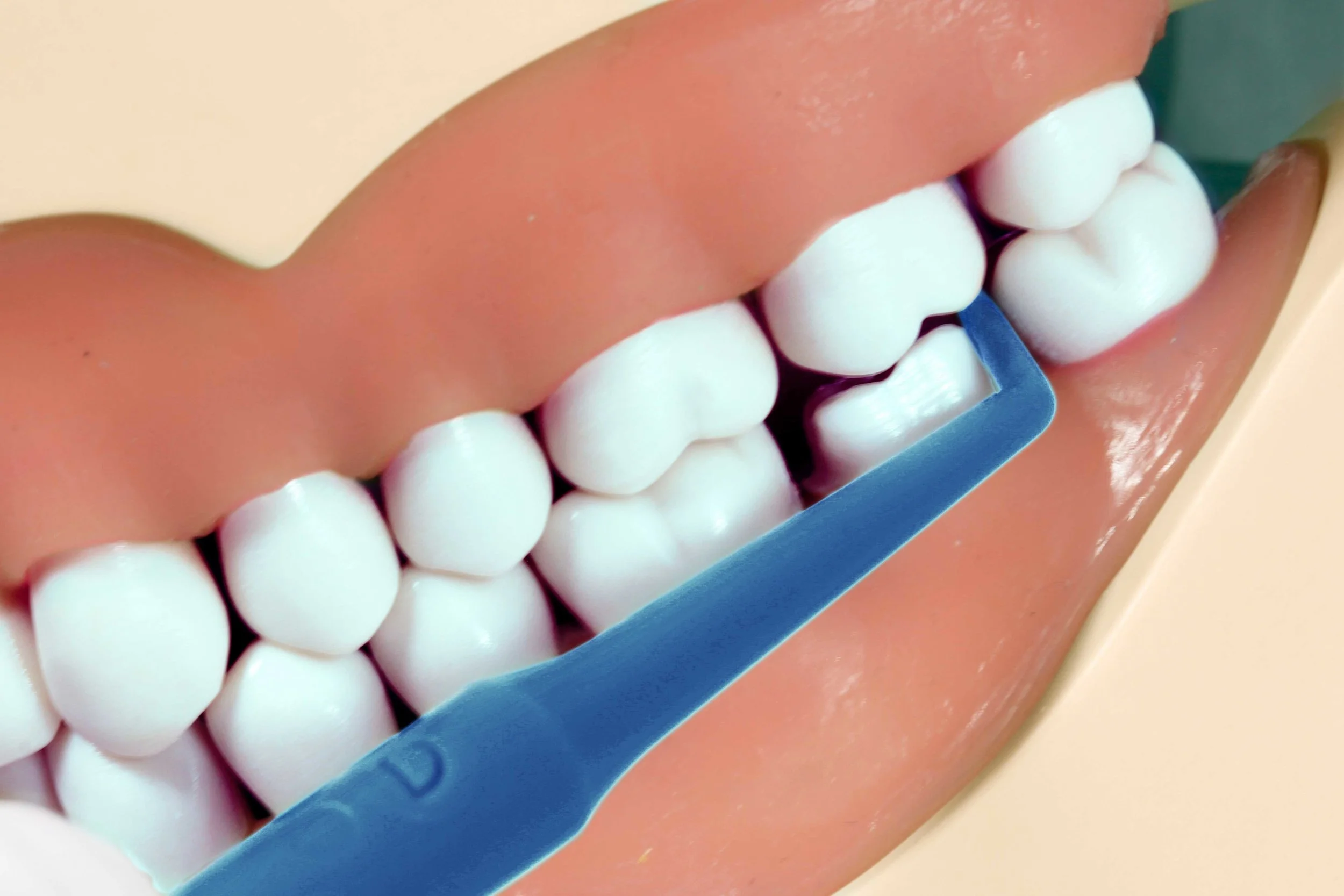 D Tip confirms distal-half clearance