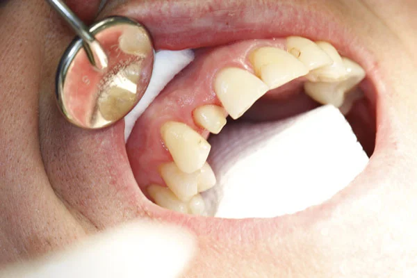 Fig. 1) The temporary crown was removed from the tooth #10 prep.