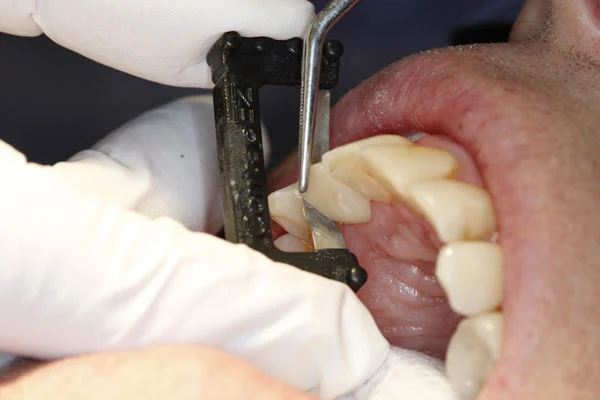 Fig. 4) Heavier contact was detected on the distal side, and so the Black Diamond Strip was passed 5-6 more times through the distal interproximal space. This process (Fig. 3 & 4) is then repeated on the mesial and distal interproximal spaces until equal light resistance on the Strip is felt on both sides. Note that the central opening of the Strip allows for easy access with cotton pliers to securely hold the crown in place. When this light resistance is achieved, the ideal proximal contact adjustment of the crown is complete and ready for cementation.